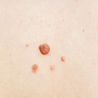 rf cautery for skin tags|Radiofrequency Skin Surgery – Everythi.